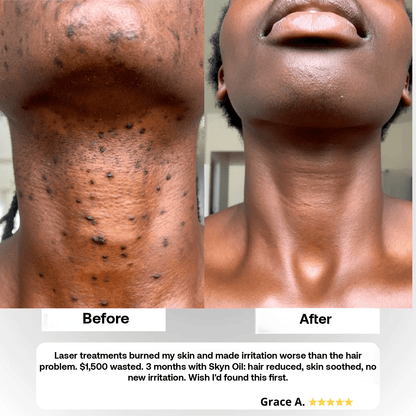 Skyn Hair Removal Serum